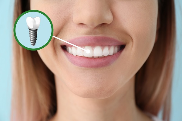 Dental Implant