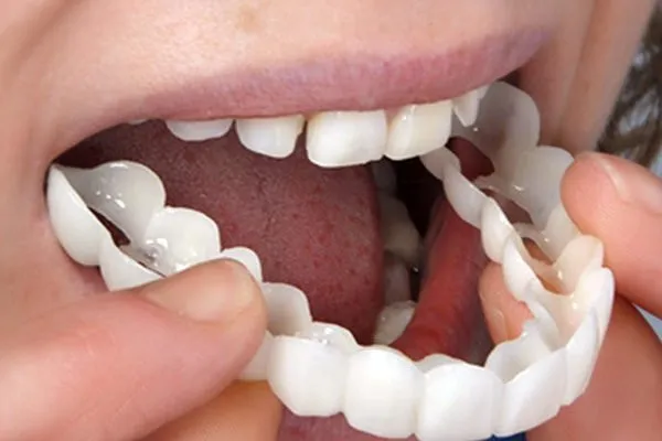 Snap-on Smile